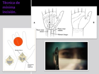 Técnica de
mínima
incisión.
 