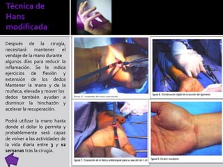 Técnica de
Hans
modificada
Después de la cirugía,
necesitará mantener el
vendaje de la mano durante
algunos días para reducir la
inflamación. Se le indica
ejercicios de flexión y
extensión de los dedos
Mantener la mano y de la
muñeca, elevada y mover los
dedos también ayudan a
disminuir la hinchazón y
acelerar la recuperación.
Podrá utilizar la mano hasta
donde el dolor lo permita y
probablemente será capaz
de volver a las actividades de
la vida diaria entre 3 y 12
semanas tras la cirugía.
 