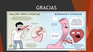 Síndrome de mallory weiss