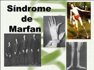 Síndrome    de   Marfan   