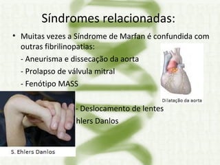 Síndromes relacionadas:  Muitas vezes a Síndrome de Marfan é confundida com outras fibrilinopatias: - Aneurisma e dissecação da aorta - Prolapso de válvula mitral - Fenótipo MASS   - Deslocamento de lentes   - Ehlers Danlos 