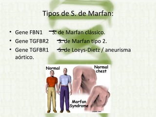 Tipos de S. de Marfan: Gene FBN1  S. de Marfan clássico. Gene TGFBR2  S. de Marfan tipo 2. Gene TGFBR1  S. de Loeys-Dietz / aneurisma aórtico. 