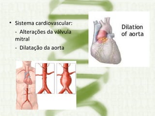Sistema cardiovascular:  -  Alterações da válvula mitral  -  Dilatação da aorta 