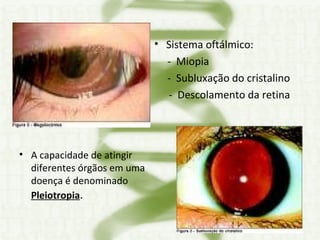 A capacidade de atingir diferentes órgãos em uma doença é denominado  Pleiotropia . Sistema oftálmico:  -  Miopia  -  Subluxação do cristalino   -  Descolamento da retina 