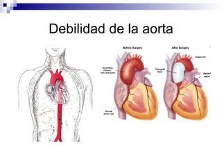 Debilidad de la aorta
 