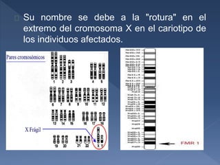 Su nombre se debe a la "rotura" en el
extremo del cromosoma X en el cariotipo de
los individuos afectados.
 