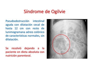 Síndrome de Ogilvie | PDF