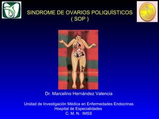 Dr. Marcelino Hernández Valencia Unidad de Investigación Médica en Enfermedades Endocrinas Hospital de Especialidades  C. M. N.  IMSS SINDROME DE OVARIOS POLIQUÌSTICOS ( SOP ) 