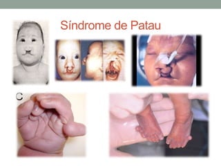 Síndrome de Patau
 