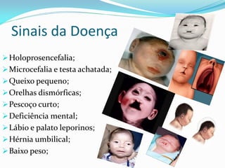 Sinais da Doença
Holoprosencefalia;
Microcefalia e testa achatada;
Queixo pequeno;
Orelhas dismórficas;
Pescoço curto;
Deficiência mental;
Lábio e palato leporinos;
Hérnia umbilical;
Baixo peso;
 
