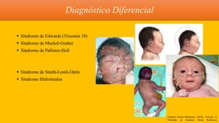  Síndrome de Edwards (Trisomía 18)
 Síndrome de Meckel-Gruber
 Síndrome de Pallister-Hall
 Síndrome de Smith-Lemli-Opitz
 Síndrome Hidroletalus
Diagnóstico Diferencial
Genetics Home Reference. (2016). Trisomy 13.
Obtenido de Genetics Home Reference.
 