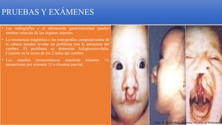 PRUEBAS Y EXÁMENES
• Las radiografías o el ultrasonido gastrointestinal pueden
mostrar rotación de los órganos internos.
• La resonancia magnética o las tomografías computarizadas de
la cabeza pueden revelar un problema con la estructura del
cerebro. El problema se denomina holoprosencefalia.
Consiste en la unión de los 2 lados del cerebro.
• Los estudios cromosómicos muestran trisomía 13,
mosaicismo por trisomía 13 o trisomía parcial.
1.Best, R. (2015). Patau Syndrome. Obtenido de Medscape.
 