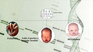 Triada Clásica:
Polidactilia Labio Leporino y
paladar hendido
Microftalmia
 