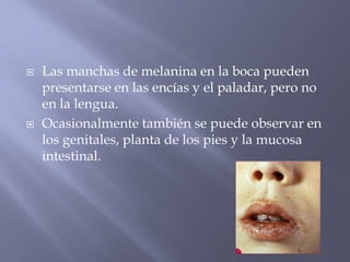 Las manchas de melanina en la boca pueden presentarse en las encías y el paladar, pero no en la lengua.  Ocasionalmente también se puede observar en los genitales, planta de los pies y la mucosa intestinal.