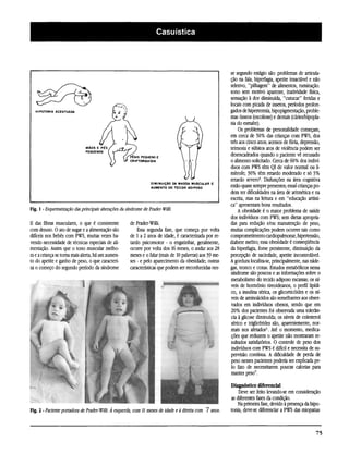 se segundo estágio são: problemas de articula-
                                                                                                       ção na fala, hiperfagia, apetite insaciável e não
                                                                                                       seletivo, "pilhagem" de alimentos, ruminação,
                                                                                                       sono sem motivo aparente, inatividade física,
                                                                                                       sensação à dor diminuída, "cutucar" feridas e
                                                                                                       locais com picada de insetos, períodos prolon-
                                                                                                       gados de hipertermia, hipopigmentação, proble-
                                                                                                       mas ósseos (escolióse) e dentais (cáries/hipopla-
                                                                                                       sia do esmalte).
                                                                                                            Os problemas de personalidade começam,
                                                                                                       em cerca de 50% das crianças com PWS, dos
                                                                                                       três aos cinco anos; acessos de fúria, depressão,
                                                                                                       teimosia e súbitos atos de violência podem ser
                                                                                                       desencadeados quando o paciente vê recusado
                                                                                                       o alimento solicitado. Cerca de 60% dos indiví-
                                                                                                       duos com PWS têm QI de valor normal ou li-
                                                                                                       mítrofe; 30% têm retardo moderado e só 3%
                                                                                                       retardo severo3. Disfunções na área cognitiva
                                                                                                       estão quase sempre presentes; essas crianças po-
                                                                                                       dem ter dificuldades na área de aritmética e na
                                                                                                       escrita, mas na leitura e em "educação artísti-
                                                                                                       ca" apresentam bons resultados.
                                                                                                            A obesidade é o maior problema de saúde
                                                                                                       dos indivíduos com PWS; sem dietas apropria-
II das fibras musculares, o que é consistente       de PraderWilli.                                    das para redução e/ou manutenção de peso,
com desuso. O ato de sugar e a alimentação são          Essa segunda fase, que começa por volta        muitas complicações podem ocorrer tais como
difíceis nos bebês com PWS, muitas vezes ha-        de l a 2 anos de idade, é caracterizada por re-    comprometimento cardiopulmonar, hipertensão,
vendo necessidade de técnicas especiais de ali-     tardo psicomotor - o engatinhar, geralmente,       diabete melito; essa obesidade é conseqüência
mentação. Assim que o tono muscular melho-          ocorre por volta dos 16 meses, o andar aos 28      da hiperfagia, fome persistente, diminuição da
ra e a criança se torna mais alerta, há um aumen-   meses e o falar (mais de 10 palavras) aos 39 me-   percepção de saciedade, apetite incontrolável.
to do apetite e ganho de peso, o que caracteri-     ses - e pelo aparecimento da obesidade; outras     A gordura localiza-se, principalmente, nas náde-
za o começo do segundo período da síndrome          características que podem ser reconhecidas nes-    gas, tronco e coxas. Estudos metabólicos nessa
                                                                                                       síndrome são poucos e as informações sobre o
                                                                                                       metabolismo do tecido adiposo escassas; os ní-
                                                                                                       veis de hormônio tireoideanos, o perfil lipídi-
                                                                                                       co, a insulina sérica, os glicorticóides e os ní-
                                                                                                       veis de aminoácidos são semelhantes aos obser-
                                                                                                       vados em indivíduos obesos, sendo que em
                                                                                                        20% dos pacientes foi observada uma tolerân-
                                                                                                        cia à glicose diminuída; os níveis de colesterol
                                                                                                        sérico e triglicérides são, aparentemente, nor-
                                                                                                       mais nos afetados1. Até o momento, medica-
                                                                                                       ções que reduzem o apetite não mostraram re-
                                                                                                       sultados satisfatórios. O controle de peso dos
                                                                                                       indivíduos com PWS é difícil e necessita de su-
                                                                                                        pervisão contínua. A dificuldade de perda de
                                                                                                        peso nesses pacientes poderia ser explicada pe-
                                                                                                        lo fato de necessitarem poucas calorias para
                                                                                                       manter peso7.

                                                                                                       Diagnóstico diferencial
                                                                                                           Deve ser feito levando-se em consideração
                                                                                                       as diferentes fases da condição.
                                                                                                           Na primeira fase, devido à presença da hipo-
                                                                                                       tonía, deve-se diferenciar a PWS das miopatias
 