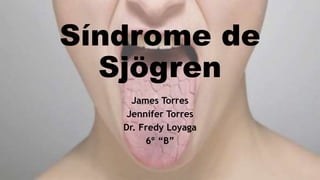 Síndrome de
Sjögren
James Torres
Jennifer Torres
Dr. Fredy Loyaga
6º “B”
 