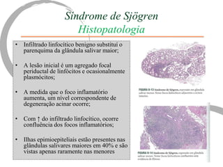 Síndrome de Sjögren
                       Histopatologia
• Infiltrado linfocítico benigno substituí o
  parenquima da glândula salivar maior;

• A lesão inicial é um agregado focal
  periductal de linfócitos e ocasionalmente
  plasmócitos;

• A medida que o foco inflamatório
  aumenta, um nível correspondente de
  degeneração acinar ocorre;

• Com ↑ do infiltrado linfocítico, ocorre
  confluência dos focos inflamatórios;

• Ilhas epimioepiteliais estão presentes nas
  glândulas salivares maiores em 40% e são
  vistas apenas raramente nas menores
 