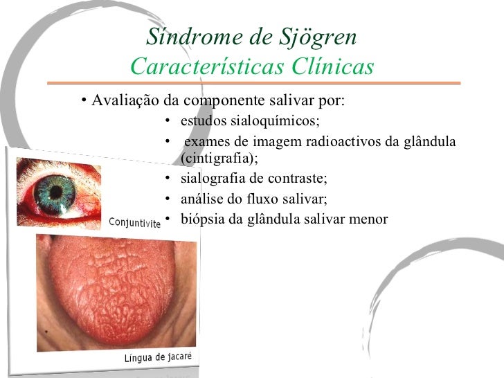 Síndrome de sjogren
