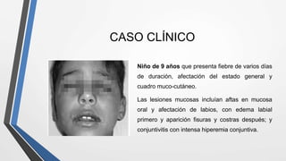 CASO CLÍNICO
Niño de 9 años que presenta fiebre de varios días
de duración, afectación del estado general y
cuadro muco-cutáneo.
Las lesiones mucosas incluían aftas en mucosa
oral y afectación de labios, con edema labial
primero y aparición fisuras y costras después; y
conjuntivitis con intensa hiperemia conjuntiva.
 
