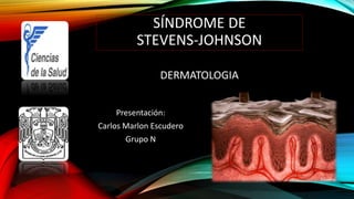 SÍNDROME DE 
STEVENS-JOHNSON 
Presentación: 
Carlos Marlon Escudero 
Grupo N 
DERMATOLOGIA 
 