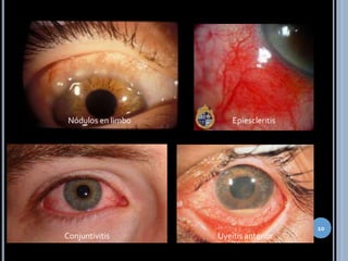 10
Nódulos en limbo Epiescleritis
Conjuntivitis Uveítis anterior
 