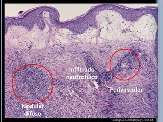 11
Infiltrado
neutrofílico
Perivascular
Nodular
difuso
Bolognia: Dermatology, 2nd ed.
 