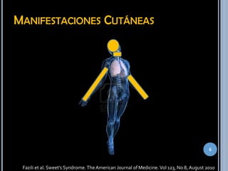MANIFESTACIONES CUTÁNEAS
6
Fazili et al. Sweet’s Syndrome. The American Journal of Medicine. Vol 123, No 8, August 2010
 