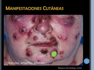 MANIFESTACIONES CUTÁNEAS
Bolognia: Dermatology, 2nd ed.
7
Pápulas eritematosas dolorosas
… crecen o coleasen
Placas de superficie irregular
Vesículas, ampollas, pústulas
 