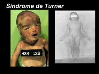 Síndrome de Turner 