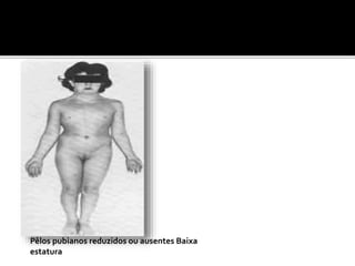 Pêlos pubianos reduzidos ou ausentes Baixa
estatura
 