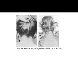 Linha posterior de implantação dos cabelos baixa (na nuca)
 