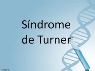 Síndrome
de Turner
 