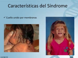 Características del Síndrome

 Cuello unido por membranas
 
