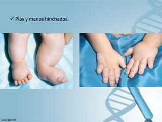  Pies y manos hinchados.
 