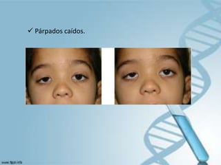  Párpados caídos.
 