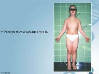  Pezones muy separados entre si.
 