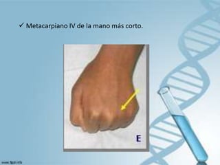  Metacarpiano IV de la mano más corto.
 