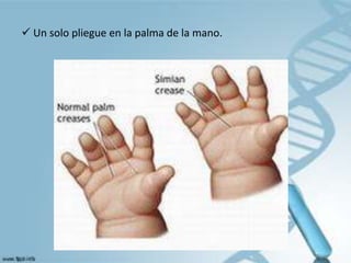  Un solo pliegue en la palma de la mano.
 