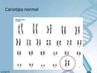 Cariotipo normal
 