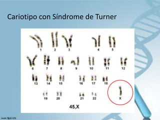 Cariotipo con Síndrome de Turner
 