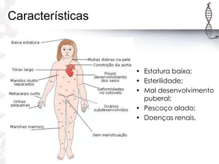 Características

• Estatura baixa;
• Esterilidade;
• Mal desenvolvimento
puberal;
• Pescoço alado;
• Doenças renais.

 