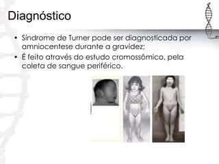 Diagnóstico
• Síndrome de Turner pode ser diagnosticada por
amniocentese durante a gravidez;
• É feito através do estudo cromossômico, pela
coleta de sangue periférico.

 