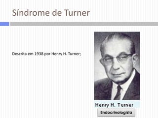 Síndrome de Turner

Descrita em 1938 por Henry H. Turner;

Endocrinologista

 