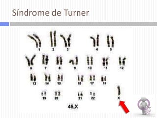 Síndrome de Turner

 