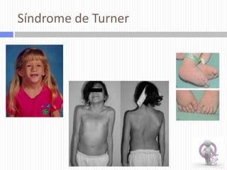 Síndrome de Turner

 