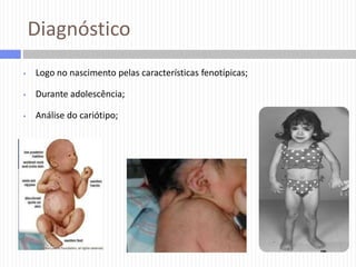 Diagnóstico


Logo no nascimento pelas características fenotípicas;



Durante adolescência;



Análise do cariótipo;

 