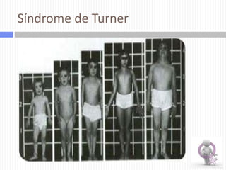 Síndrome de Turner

 