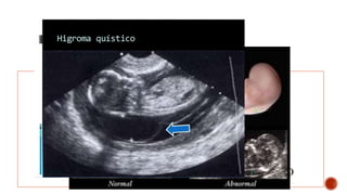 •Hidropesía fetal.
•Aumento en la translucencia nucal
•Higroma quístico
•Polihidramnios
•Retardo en el crecimiento intrauterino
SOSPECHA PRENATAL
-Hallazgos ultrasonográficos-
 