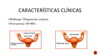 Hallazgo: Disgenesia ovárica
Frecuencia: 90-96%
 