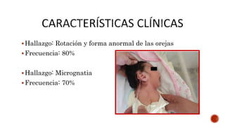Hallazgo: Rotación y forma anormal de las orejas
Frecuencia: 80%
Hallazgo: Micrognatia
Frecuencia: 70%
 